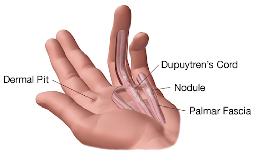 Palmar Fibromatosis