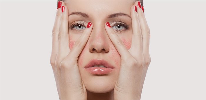 Rosacea and Essential Oils to soothe symptoms