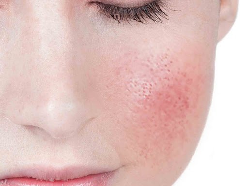 Rosacea and Essential Oils as a Natural Alternative to Help Symptoms