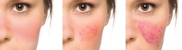 Rosacea and EO for Symptoms