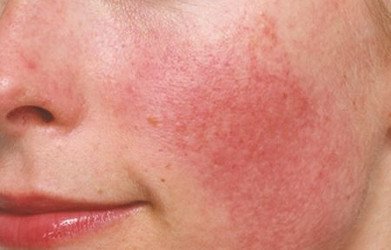 Rosacea natural remedies EverPhi